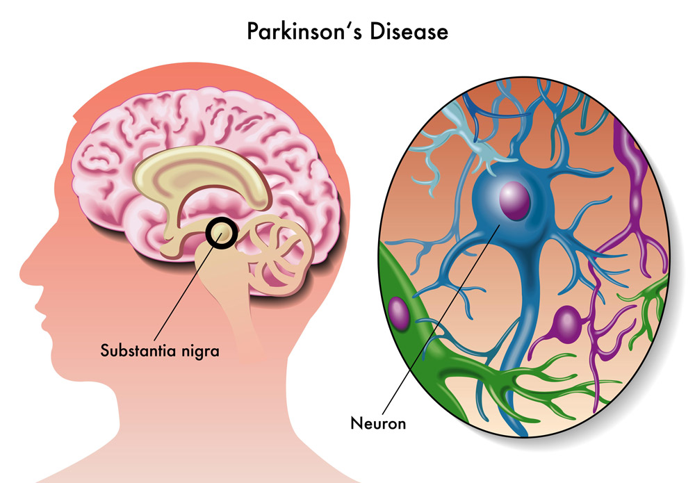 Os sinais prematuros do Parkinson